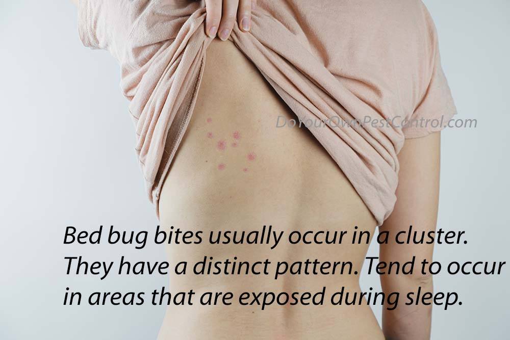 bed bug bites 1