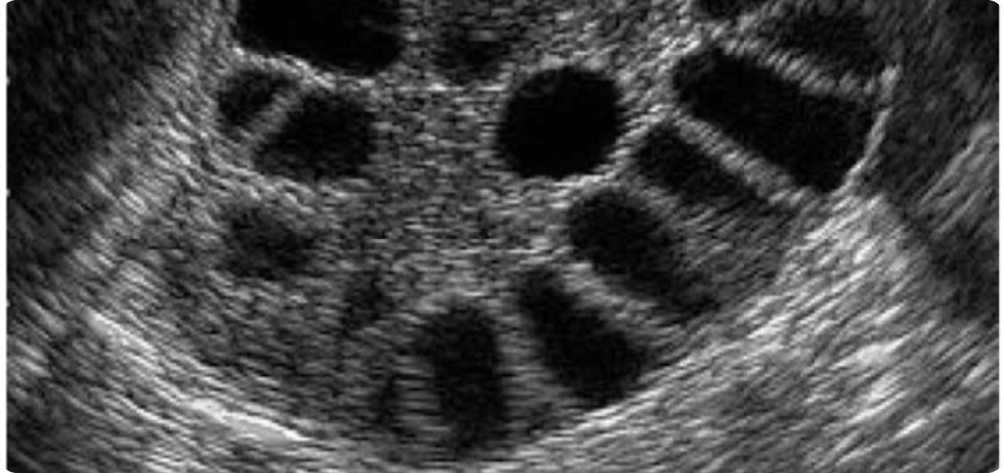 PCOS im Ultraschall