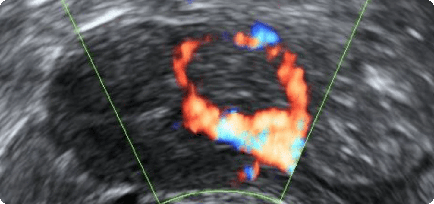 Gelbkörper im Ultraschall