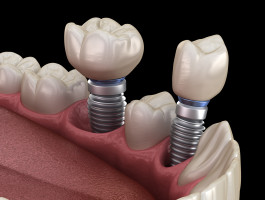 Die Installation einer Prämolaren- und Molaren-Zahnkrone über Implantatpfeilern. Medizinisch exakte 3D-Darstellung von menschlichen Zähnen und Zahnersatzkonzepten.