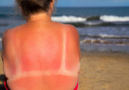 Eine Person mit starkem Sonnenbrand auf dem Rücken sitzt am Strand nahe dem Meer. Man sieht die Rötung durch den Sonnenbrand sowie hellere Hautstreifen an den Stellen, wo Kleidung war. Im Hintergrund sind das Meer und die Wellen zu sehen.