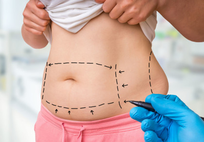 Eine Person hebt ihr T-Shirt hoch und zeigt ihren Bauch. Auf dem Bauch sind gestrichelte Linien und Pfeile gezeichnet, die einen Bereich markieren. Eine Hand mit einem blauen Handschuh hält einen Stift und zeichnet auf dem Bauch.