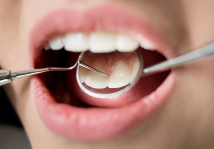 Nahaufnahme eines Mundes mit geöffneten Lippen, bei einer zahnärztlichen Untersuchung. Ein Zahnspiegel und ein zahnärztliches Werkzeug werden verwendet, um die Zähne zu inspizieren.