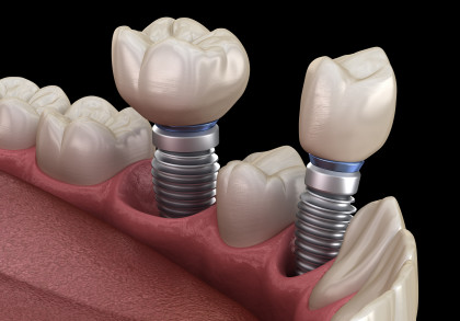 Die Installation einer Prämolaren- und Molaren-Zahnkrone über Implantatpfeilern. Medizinisch exakte 3D-Darstellung von menschlichen Zähnen und Zahnersatzkonzepten.