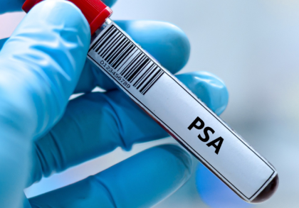 Blutprobe mit der Aufschrift PSA im Labor: Symbolbild für den PSA-Test zur Früherkennung von Prostatakrebs und zur Beurteilung der Prostatagesundheit im Rahmen der Vorsorgeuntersuchung.