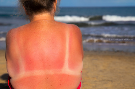 Eine Person mit starkem Sonnenbrand auf dem Rücken sitzt am Strand nahe dem Meer. Man sieht die Rötung durch den Sonnenbrand sowie hellere Hautstreifen an den Stellen, wo Kleidung war. Im Hintergrund sind das Meer und die Wellen zu sehen.