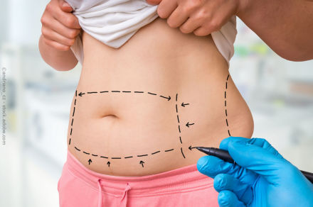 Eine Person hebt ihr T-Shirt hoch und zeigt ihren Bauch. Auf dem Bauch sind gestrichelte Linien und Pfeile gezeichnet, die einen Bereich markieren. Eine Hand mit einem blauen Handschuh hält einen Stift und zeichnet auf dem Bauch.