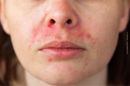 Nahaufnahme eines Gesichts mit Hautrötungen und kleinen Pickeln um die Nase und den Mund herum.