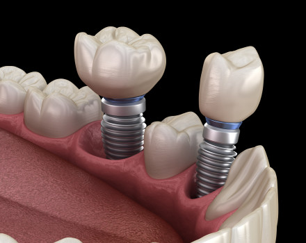 Die Installation einer Prämolaren- und Molaren-Zahnkrone über Implantatpfeilern. Medizinisch exakte 3D-Darstellung von menschlichen Zähnen und Zahnersatzkonzepten.
