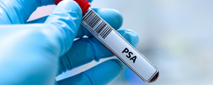 Blutprobe mit der Aufschrift PSA im Labor: Symbolbild für den PSA-Test zur Früherkennung von Prostatakrebs und zur Beurteilung der Prostatagesundheit im Rahmen der Vorsorgeuntersuchung.