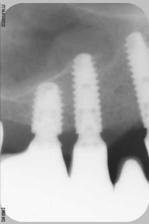 046 nglido - Eugenol