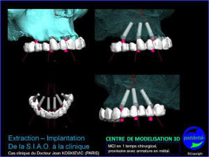 15 extraction mci bridge provisoire avec armature m tal tiv52l - Eugenol
