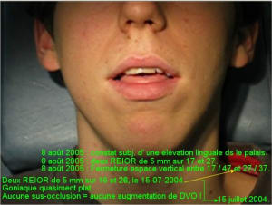 2004 2005 beance anterieure biyjab - Eugenol
