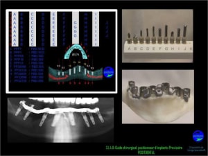 24 extraction mci bridge provisoire avec armature m tal inplt9 - Eugenol