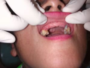 5 sem post op qnkj0p - Eugenol