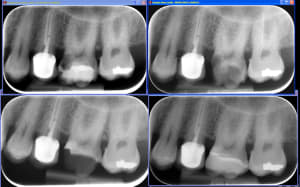 Biodentineremontedemargeonlay ykgexl - Eugenol