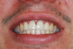 Essai zircone eqhcek - Eugenol