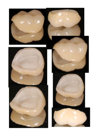 Emax press e sur zircone joint c ramique sns791 - Eugenol