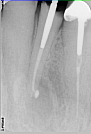 Endo 12 ybagem - Eugenol