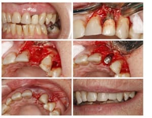 Exo 22   implant tempo  custom  vu1qvg - Eugenol