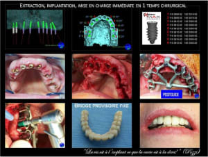 Extraction implantation mci implants leone positdental  jylwuu - Eugenol