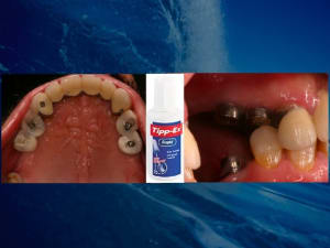 Fracasos - Eugenol