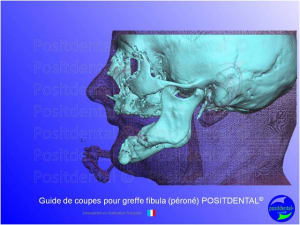 Guide de coupes pour greffe fibula  p ron   positdental 002 plhgin - Eugenol
