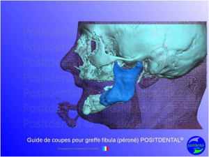 Guide de coupes pour greffe fibula  p ron   positdental 003 rdmv2i - Eugenol