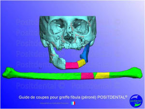 Guide de coupes pour greffe fibula  p ron   positdental 004 fse18a - Eugenol