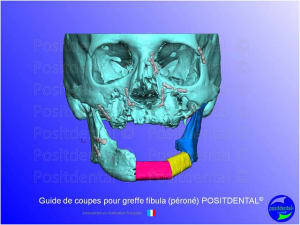 Guide de coupes pour greffe fibula  p ron   positdental 009 jjinyf - Eugenol