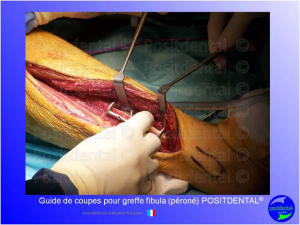Guide de coupes pour greffe fibula  p ron   positdental 014 kvau1d - Eugenol