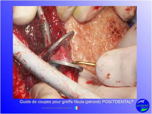 Guide de coupes pour greffe fibula  p ron   positdental 017 twiltf - Eugenol