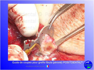 Guide de coupes pour greffe fibula  p ron   positdental 018 lp5wwr - Eugenol