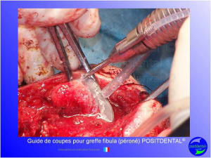 Guide de coupes pour greffe fibula  p ron   positdental 024 wkbdf6 - Eugenol