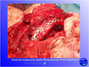Guide de coupes pour greffe fibula  p ron   positdental 031 fdqbie - Eugenol