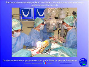 Guide de coupes pour greffe fibula  p ron    positdental 010 ywbhtj - Eugenol