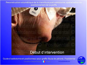 Guide de coupes pour greffe fibula  p ron    positdental 011 twi7rp - Eugenol