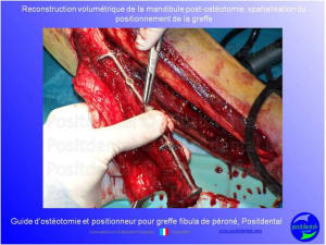 Guide de coupes pour greffe fibula  p ron    positdental 016 fu5y5a - Eugenol