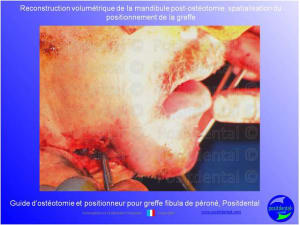Guide de coupes pour greffe fibula p ron positdental 029 no8itl - Eugenol