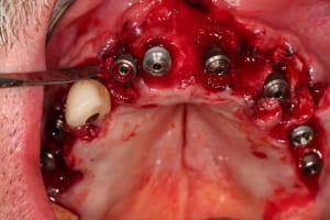 Img implants l7t0rq - Eugenol