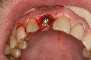 Implant 11 006 ppz7nf - Eugenol