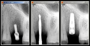 Implant 25 v8spz1 - Eugenol
