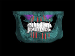 Implant dentsply ankylos et mci 001 wxwueq - Eugenol