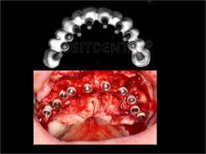 Implant tbr z1 et mci 005 cxiyoh - Eugenol