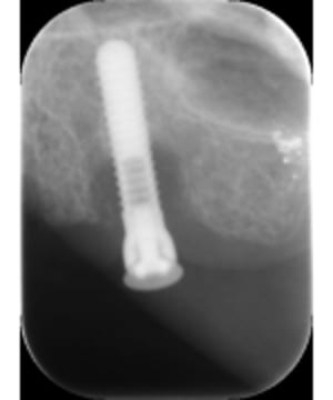 Implant izlyjk - Eugenol