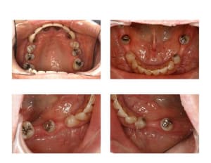 Implants case kxkjeg - Eugenol