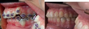 Miniscrewa3 s8sdrh - Eugenol