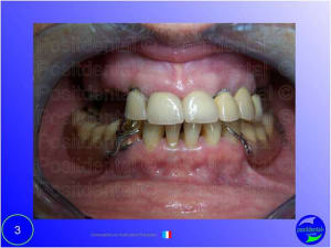 Mise en chage imm diate 003 opr7x2 - Eugenol