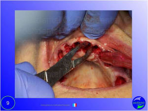 Mise en chage imm diate 009 pfy3ms - Eugenol