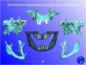 Mise en chage imm diate 031 wodl1n - Eugenol